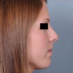 Rhinoplasty Before & After Patient #601