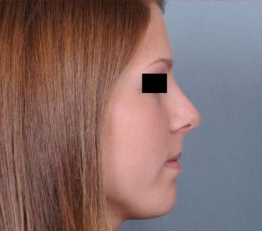 Rhinoplasty Before & After Patient #601