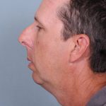 Chin Implants Before & After Patient #4370