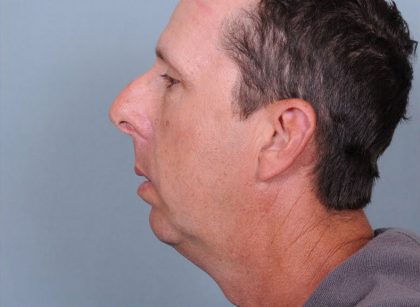 Chin Implants Before & After Patient #4370