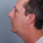 Chin Implants Before & After Patient #4370