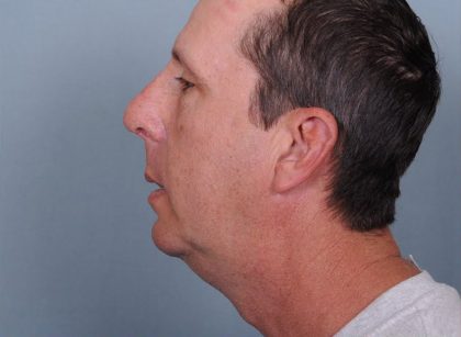 Chin Implants Before & After Patient #602