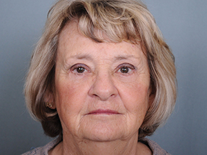 Blepharoplasty Before & After Patient #599