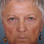 Blepharoplasty Before & After Patient #598