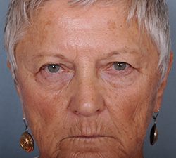 Blepharoplasty Before & After Patient #598