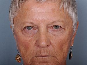 Blepharoplasty Before & After Patient #598