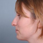 Rhinoplasty Before & After Patient #597