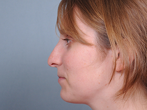 Rhinoplasty Before & After Patient #597