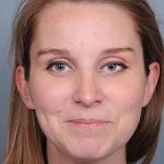 Rhinoplasty Before & After Patient #597