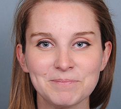 Rhinoplasty Before & After Patient #597