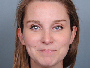 Rhinoplasty Before & After Patient #597