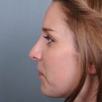 Rhinoplasty Before & After Patient #597