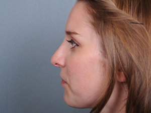 Rhinoplasty Before & After Patient #597