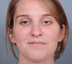 Rhinoplasty Before & After Patient #597
