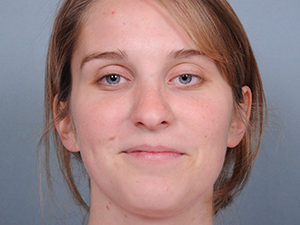 Rhinoplasty Before & After Patient #597