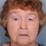 Blepharoplasty Before & After Patient #669