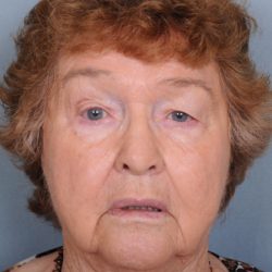 Blepharoplasty Before & After Patient #669