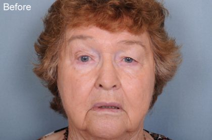 Blepharoplasty Before & After Patient #669