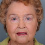 Blepharoplasty Before & After Patient #669