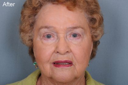 Blepharoplasty Before & After Patient #669