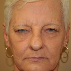 Blepharoplasty Before & After Patient #668