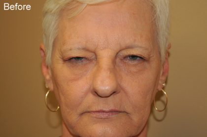 Blepharoplasty Before & After Patient #668