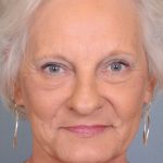 Blepharoplasty Before & After Patient #668