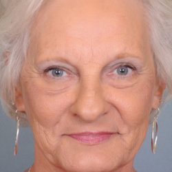 Blepharoplasty Before & After Patient #668