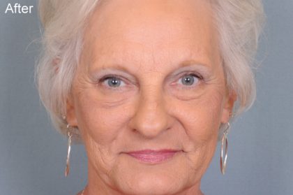 Blepharoplasty Before & After Patient #668