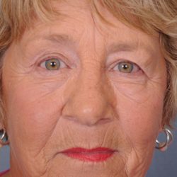 Blepharoplasty Before & After Patient #667