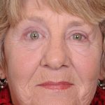 Blepharoplasty Before & After Patient #667