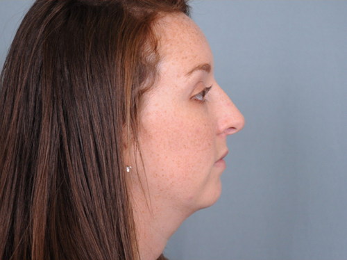 Chin Implants Before & After Patient #666