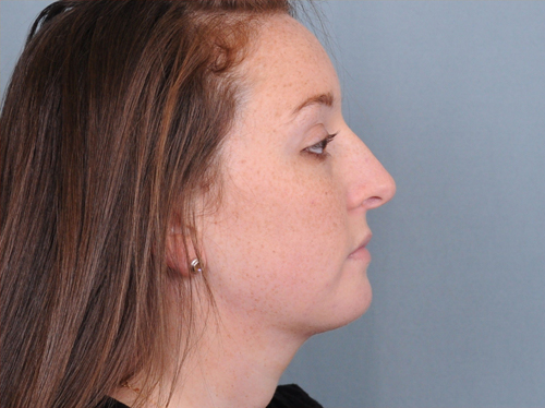 Chin Implants Before & After Patient #666