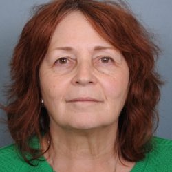 Facelift Before & After Patient #665