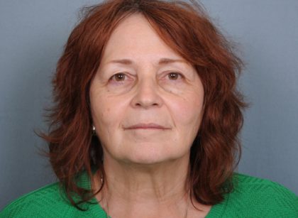 Facelift Before & After Patient #665