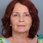 Facelift Before & After Patient #665