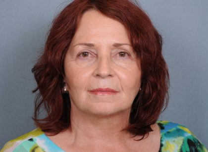 Facelift Before & After Patient #665