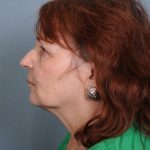 Facelift Before & After Patient #665