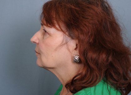 Facelift Before & After Patient #665