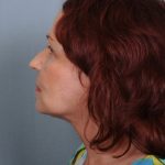 Facelift Before & After Patient #665