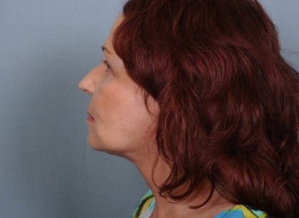 Facelift Before & After Patient #665