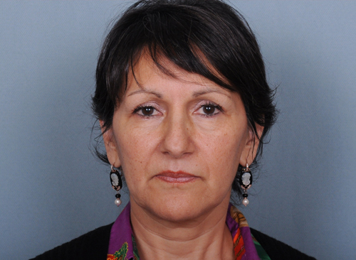 Facelift Before & After Patient #664