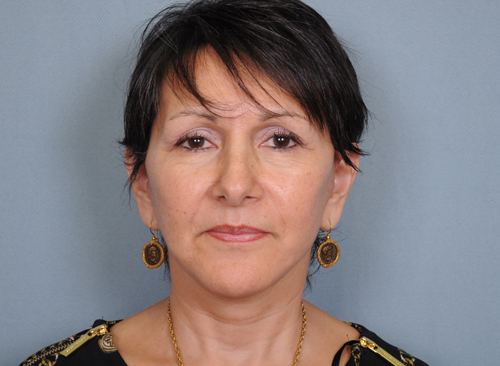 Facelift Before & After Patient #664