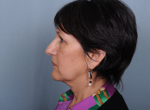 Facelift Before & After Patient #664