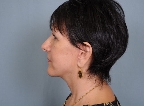 Facelift Before & After Patient #664