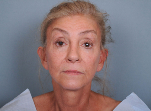 Facelift Before & After Patient #663