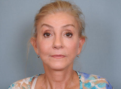Facelift Before & After Patient #663