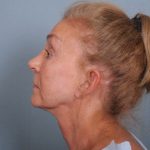 Facelift Before & After Patient #663