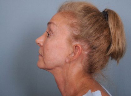 Facelift Before & After Patient #663