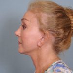 Facelift Before & After Patient #663